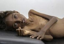 Yemen’s children starve as war drags on