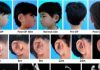 In World First, Children Given New Ears Grown From Their Own Cells