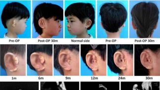 In World First, Children Given New Ears Grown From Their Own Cells